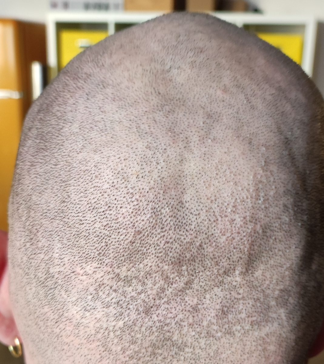 Back of a shaved head showing widespread small round scars across the donor area after a failed FUE hair transplant