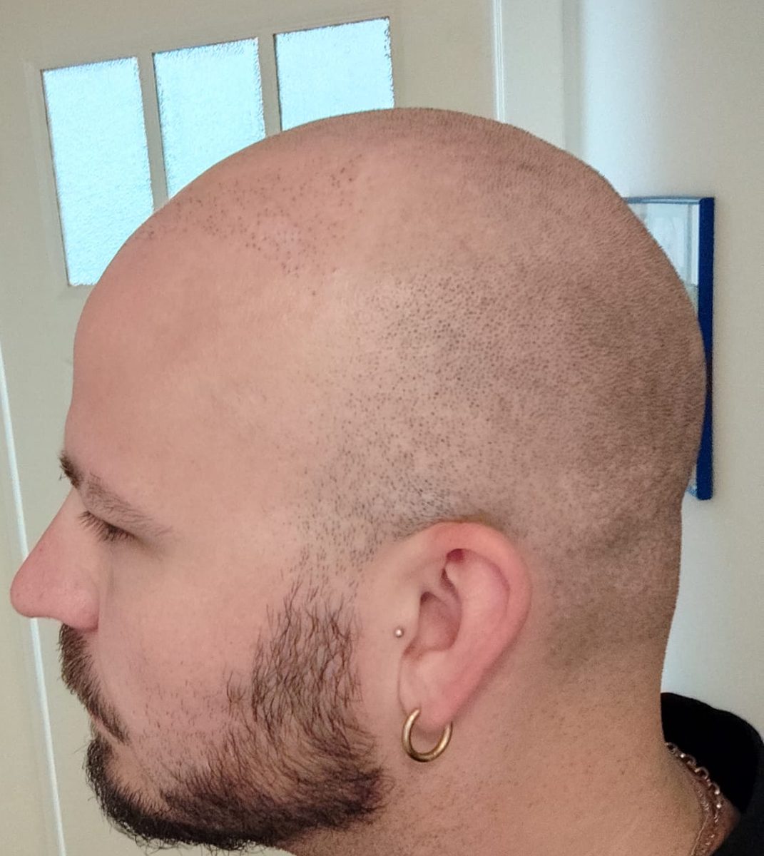 Side profile of a shaved head after a failed hair transplant, showing sparse scattered grafts across the top and extraction scarring lower down