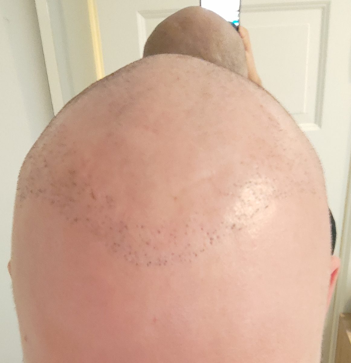 Top down view of a shaved scalp showing a sparse line of transplanted grafts where a hairline was attempted