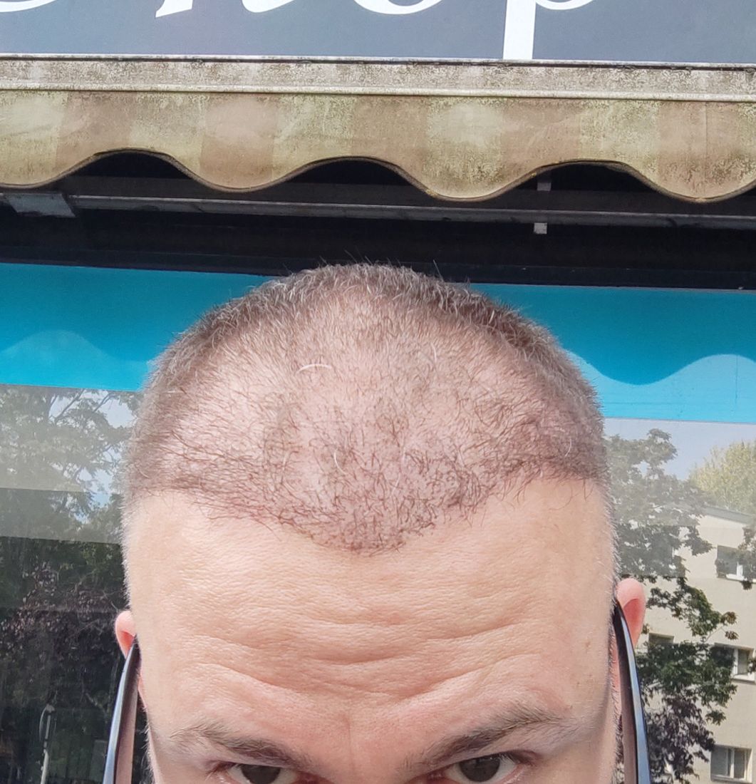 Close view of a scalp around two months after a transplant showing early sparse regrowth