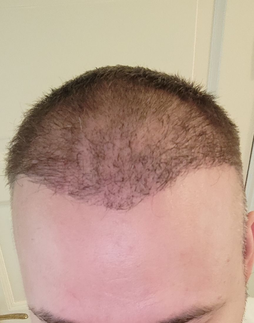 Top down view around three months after a hair transplant showing hair filling in across the front