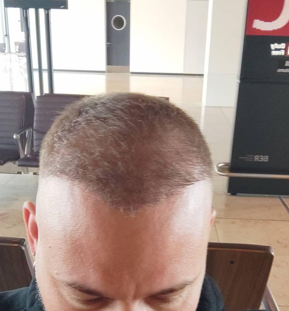 Man photographed from above around four months after a hair transplant with noticeably thicker hair