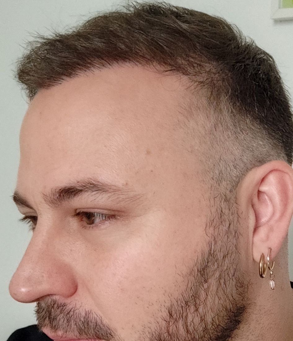 Side profile around ten months after a hair transplant showing the restored hairline and temple