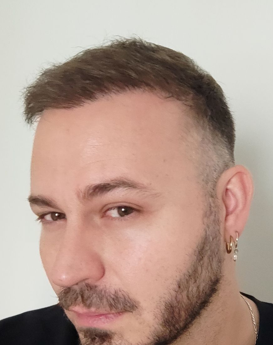 Three quarter view around ten months after a hair transplant with hair styled forward