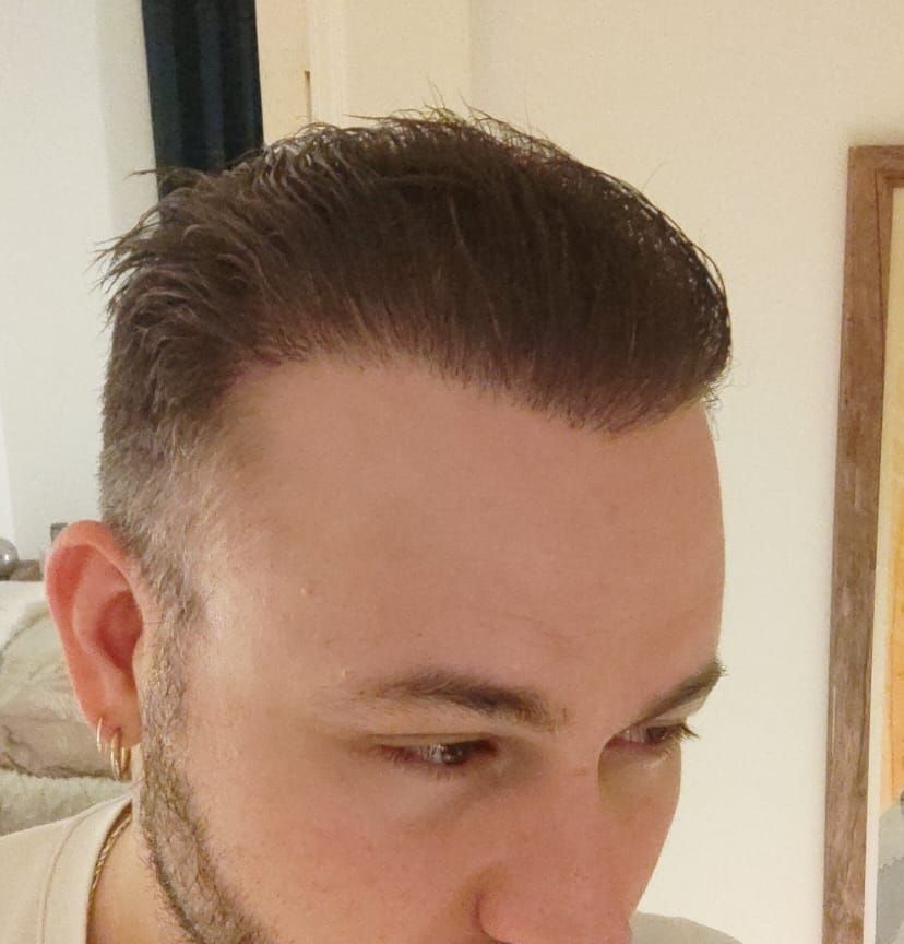 Man with hair styled back just after twelve months following a hair transplant
