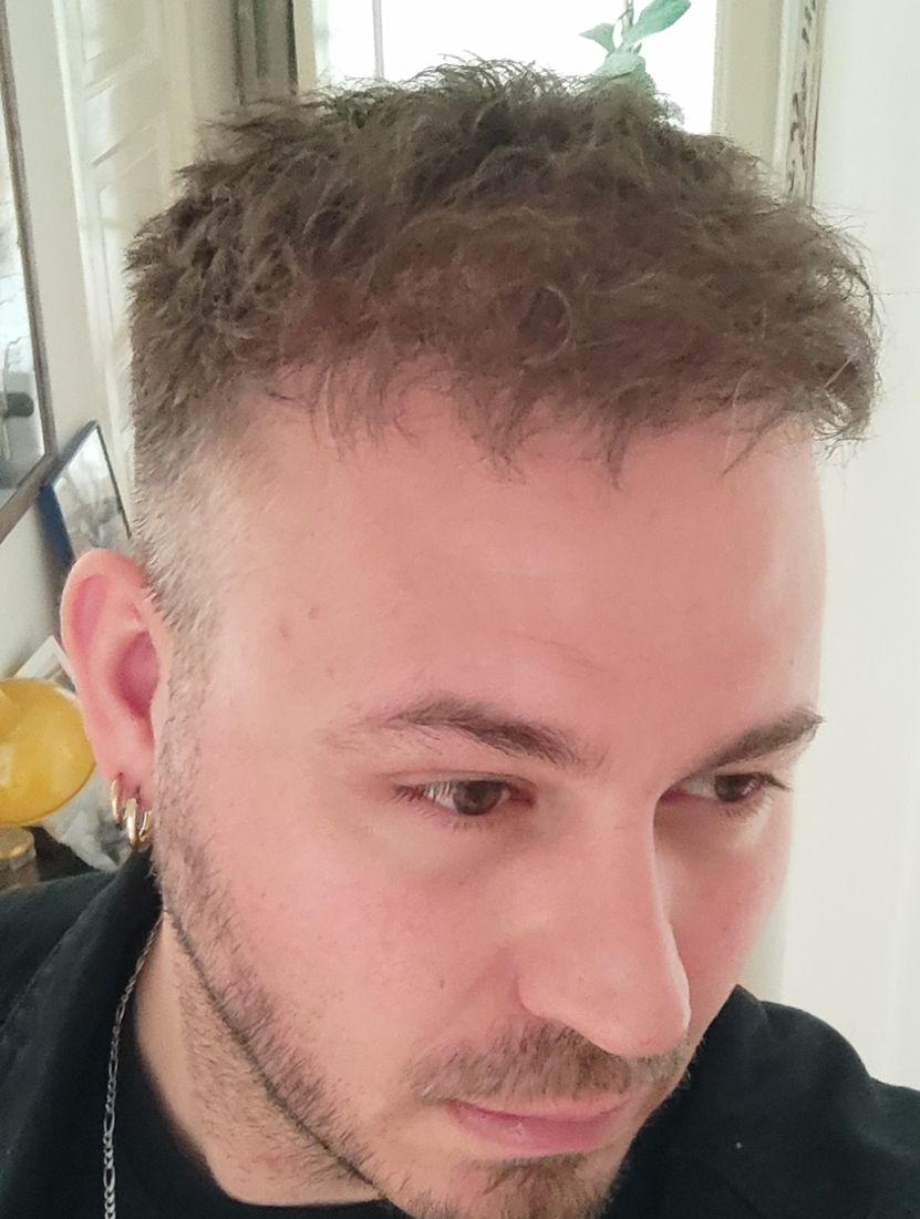 Close view of a man with full hair styled back, showing the restored hairline