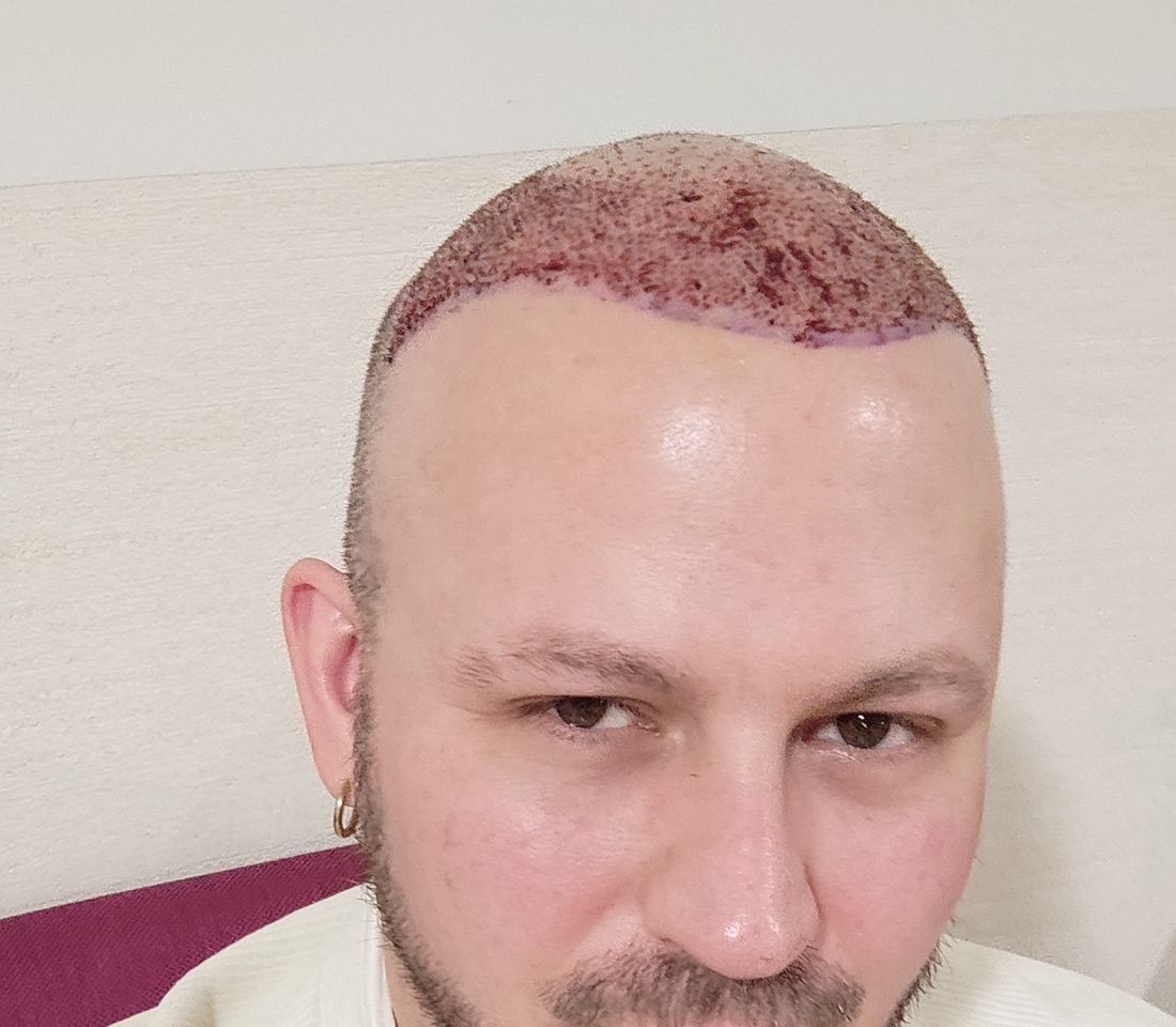 Close up of a scalp the day after a hair transplant showing dense red graft sites along the new hairline
