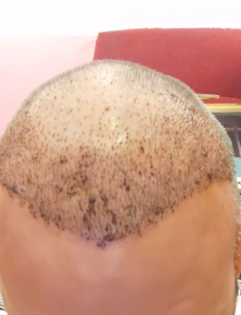 Top down view of a scalp around five days after a hair transplant showing crusting over the graft sites