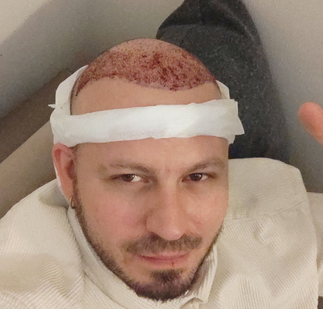 Man with a surgical head bandage and freshly transplanted grafts across the front of the scalp