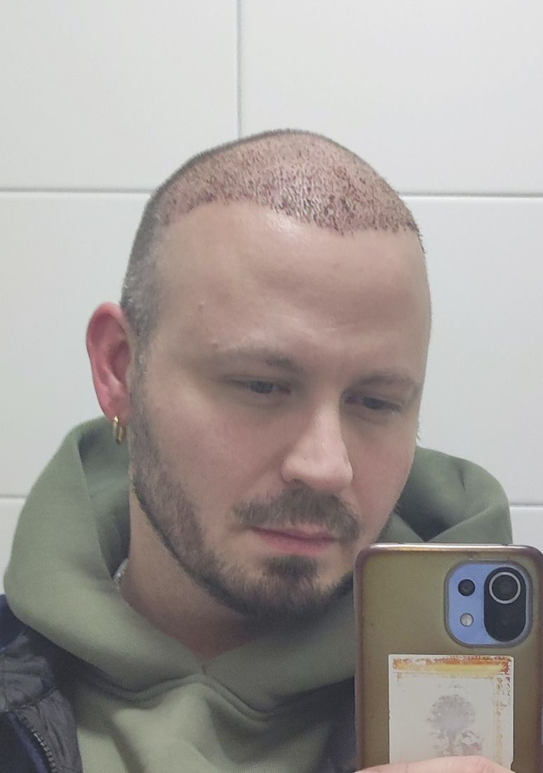 Man photographed in a mirror about a week after a hair transplant, grafts visible but crusting reduced