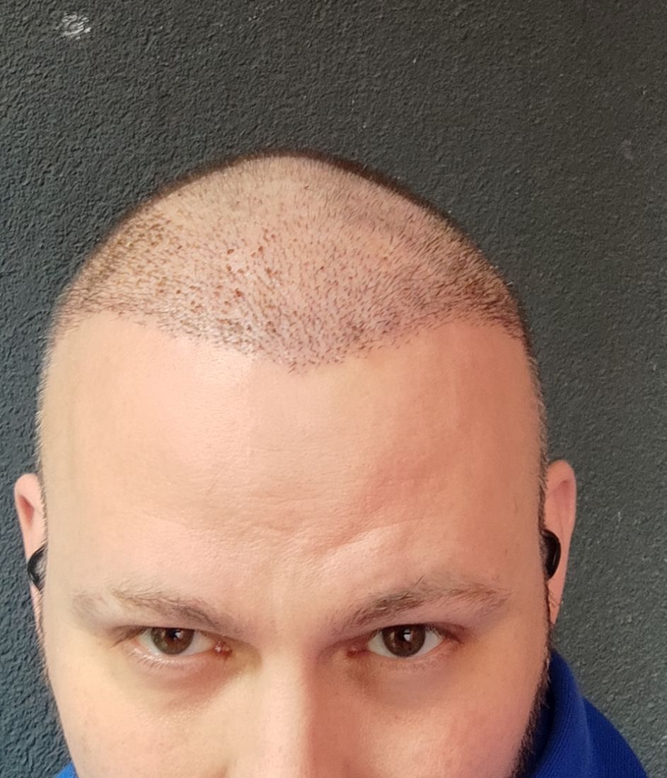 Front view about two weeks after a hair transplant showing the transplanted area settling
